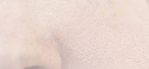 Enlarged Pores