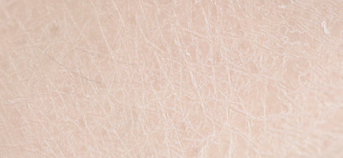 Dehydrated skin