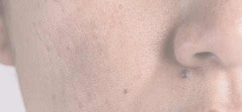 Hyperpigmentation
