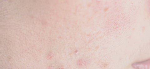 Sensitive skin