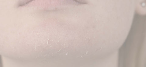 Dry and cracked skin